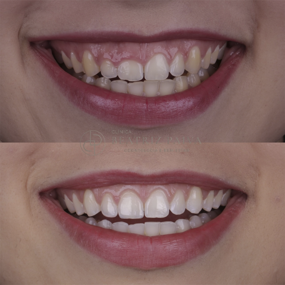 Gengivoplastia