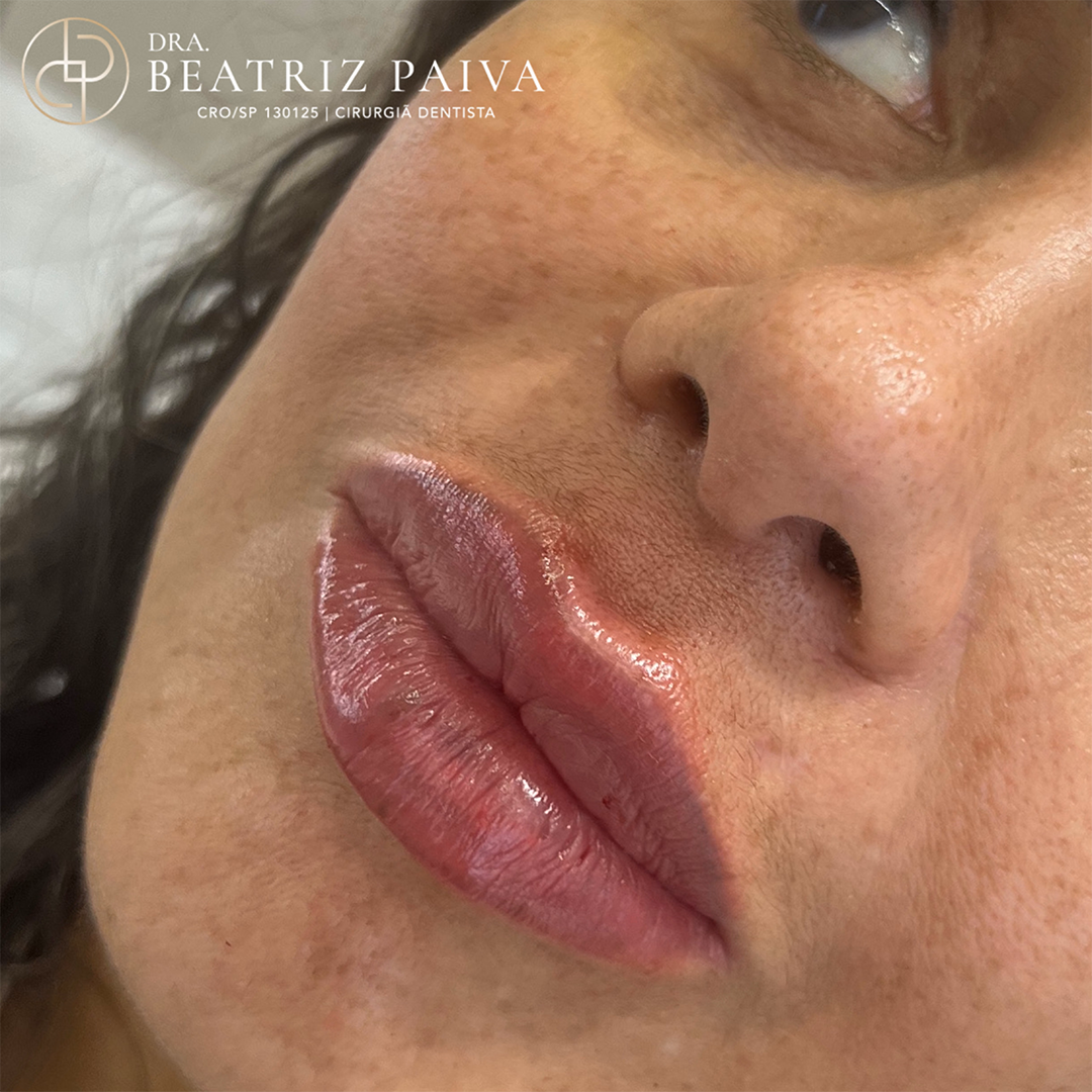 Preenchimento Labial